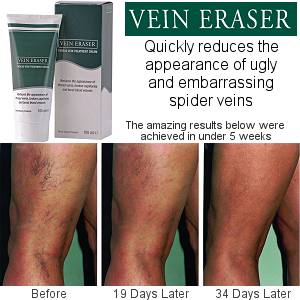 BCD Vein Eraser Thread Vein Treatment Cream (100ml)
